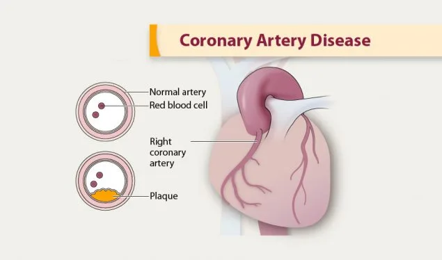 Understanding the Three Types of Coronary Artery Disease Unraveling the Hidden Threats to Heart Health