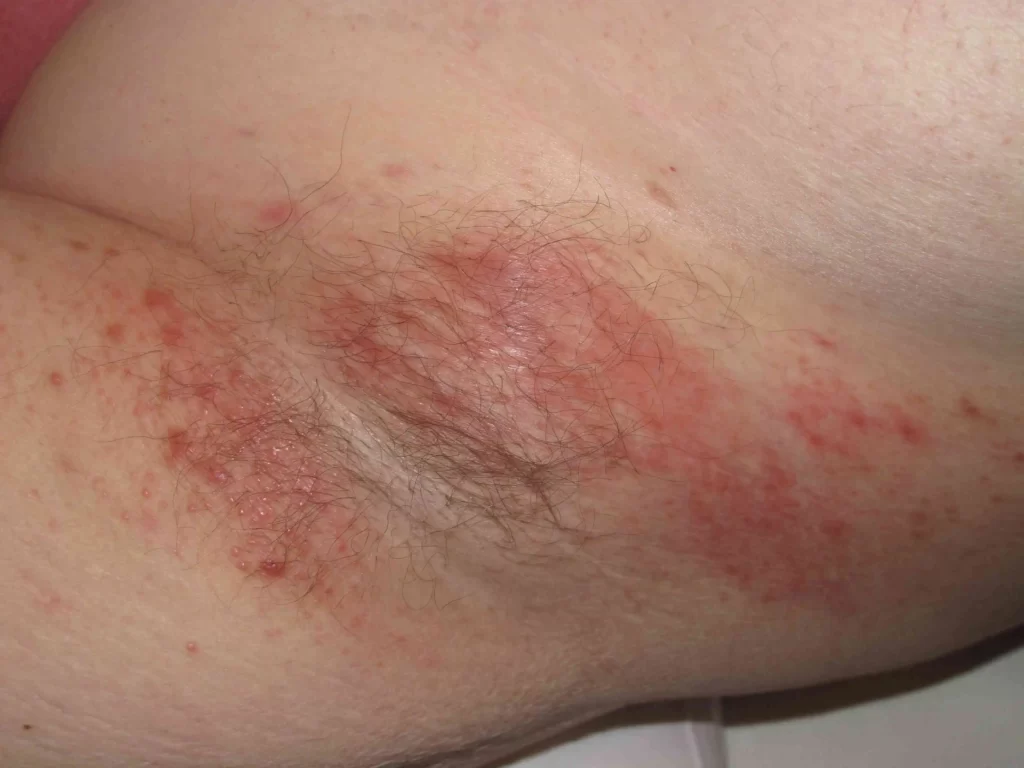 When should I be worried about armpit rash?