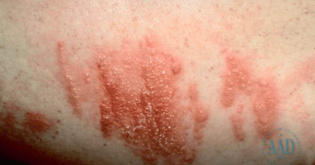  Irritant Skin