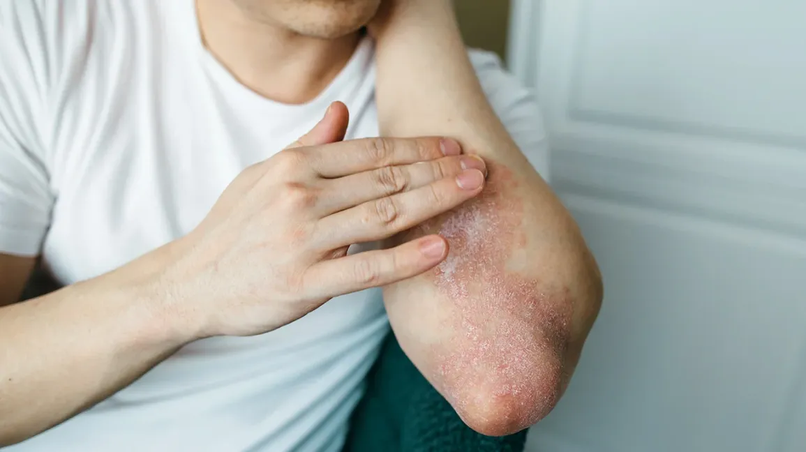Can I get rid of psoriasis