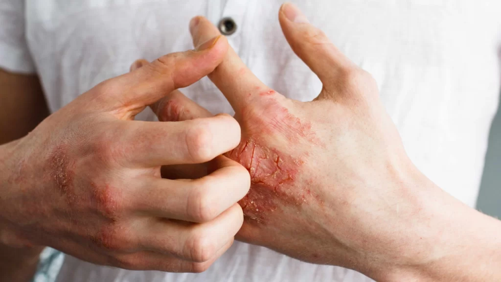 How to Treat Eczema Rash and Find Relief Guide