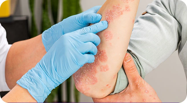 Is eczema a fungal infection Terrifying? Explain in 3+ Way.