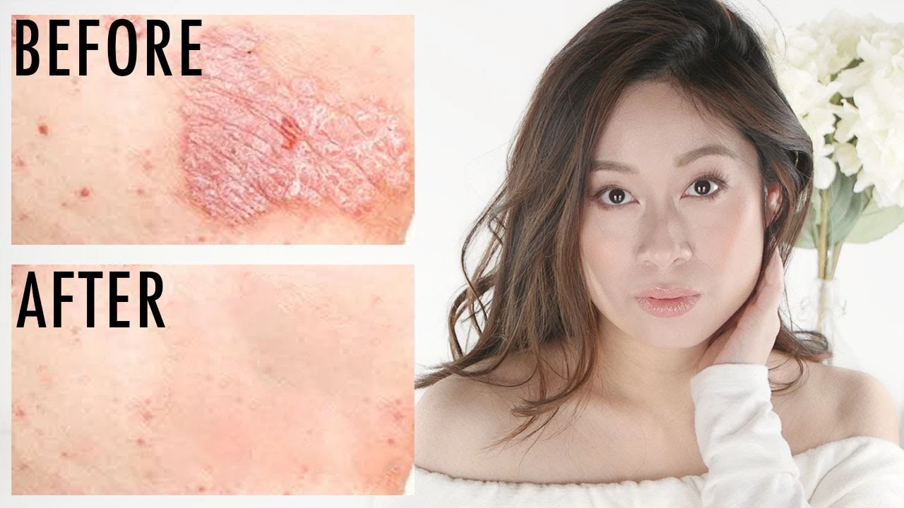 Psoriasis How To Get Rid of Itchy Scaly Skin