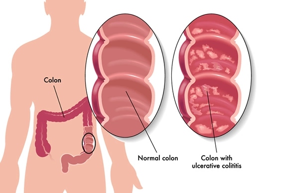 Understanding-Ulcerative-Colitis-Navigating-the-Path-to-Wellness