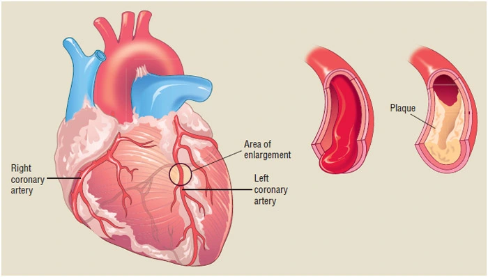 What are the 3 types of coronary artery disease