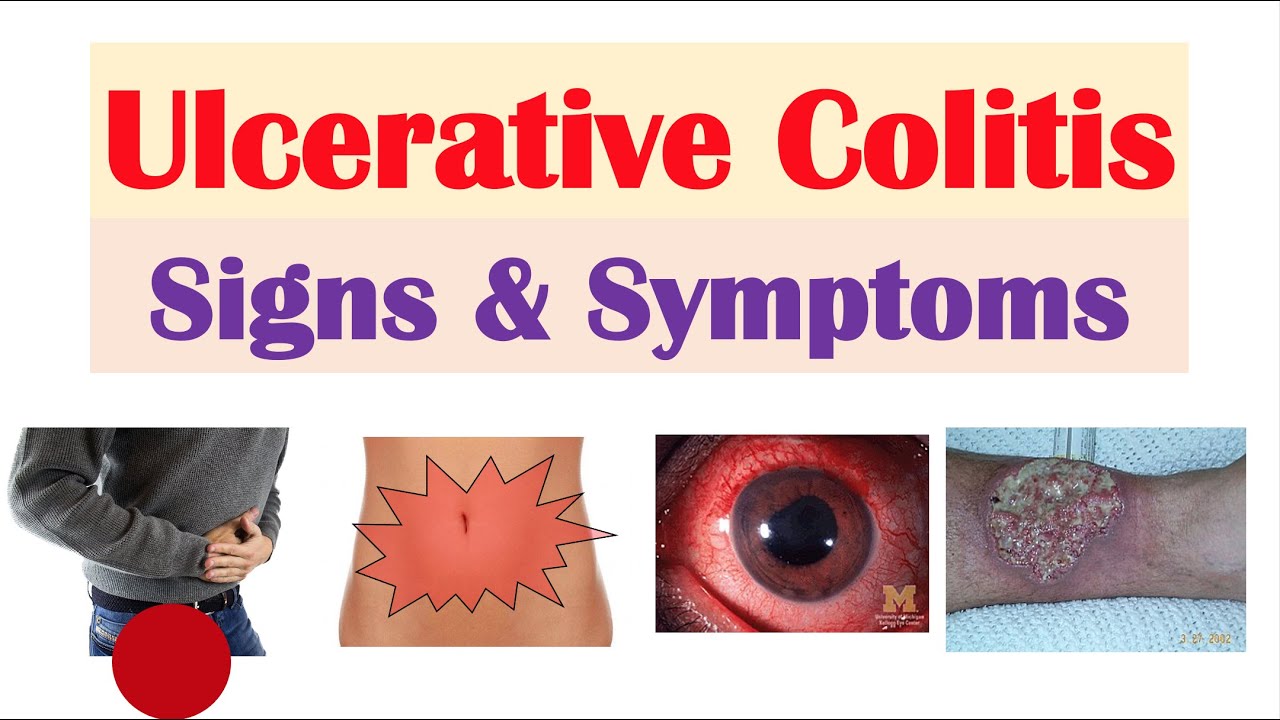 What are the warning signs of ulcerative colitis