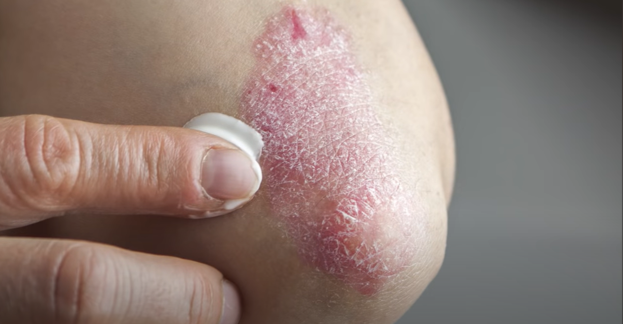 Eczema Breakthrough: Revolutionary Treatment Unveiled of 2023