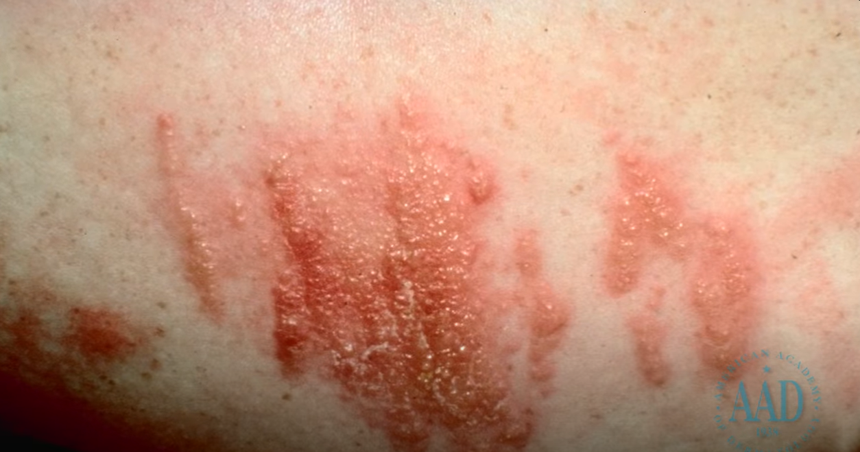 causes of eczema