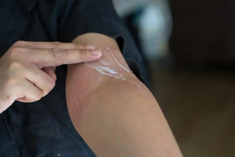 Does eczema go away by itself