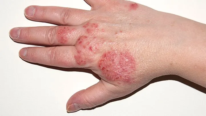 What are the 3 symptoms of eczema Unbelievable?